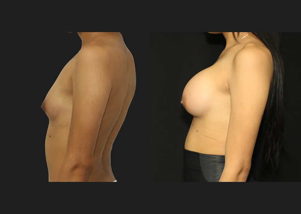 20250910-1 Breast Augmentation MTF Top Surgery Allergan Saline Implants High Profile 400 cc submuscular dual plane Before After 6 weeks left