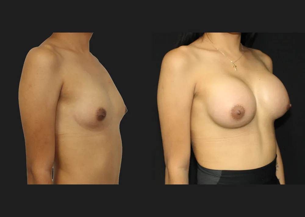 20250910-1 Breast Augmentation MTF Top Surgery Allergan Saline Implants High Profile 400 cc submuscular dual plane Before After 6 weeks right oblique