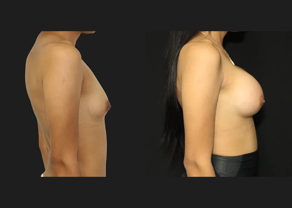 20250910-1 Breast Augmentation MTF Top Surgery Allergan Saline Implants High Profile 400 cc submuscular dual plane Before After 6 weeks right