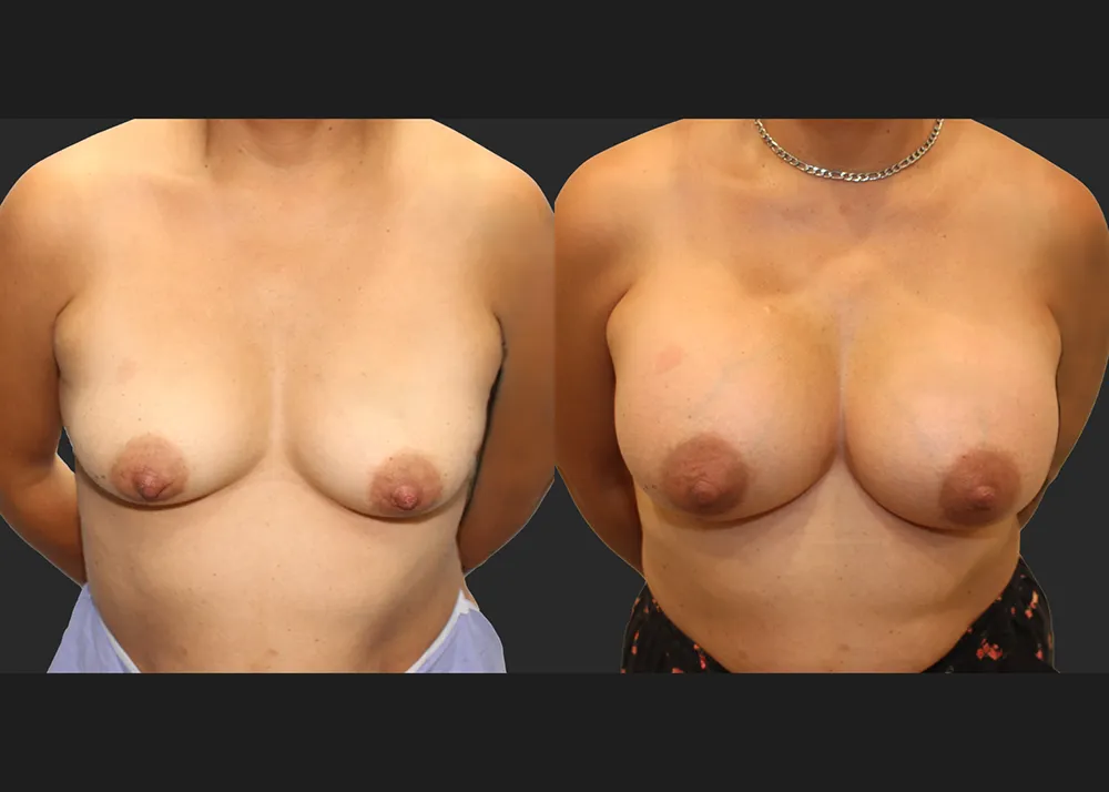 320586 Breast Aug Saline Implants 68 High Profile 500 cc (R 500 L 550) submuscular before after 7 wks cleavage