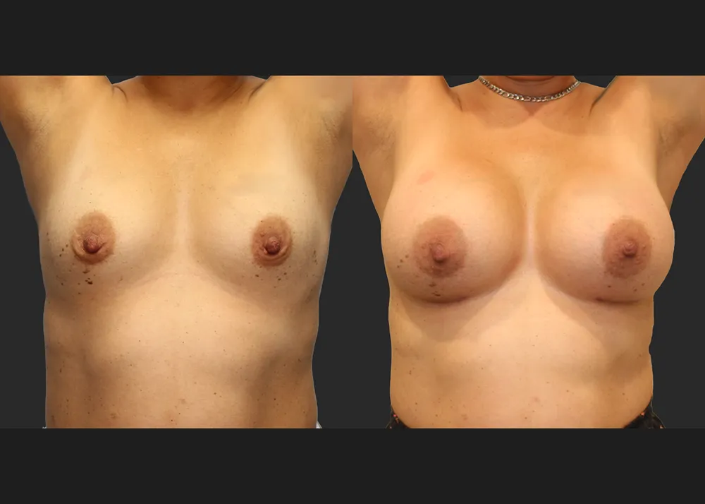 320586 Breast Aug Saline Implants 68 High Profile 500 cc (R 500 L 550) submuscular before after 7 wks front up