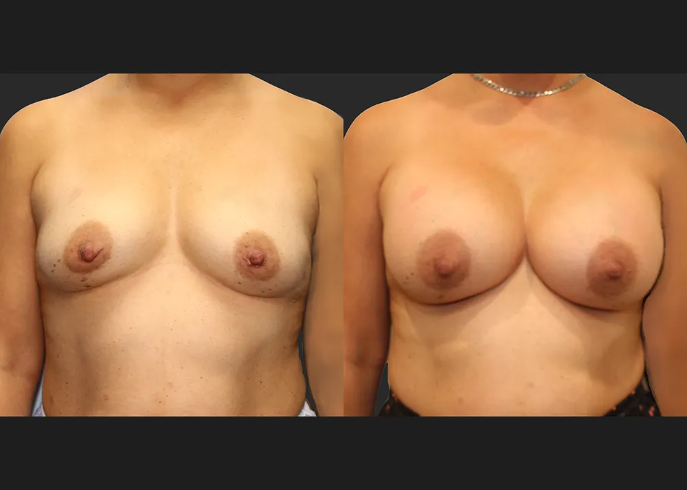 320586 Breast Aug Saline Implants 68 High Profile 500 cc (R 500 L 550) submuscular before after 7 wks front