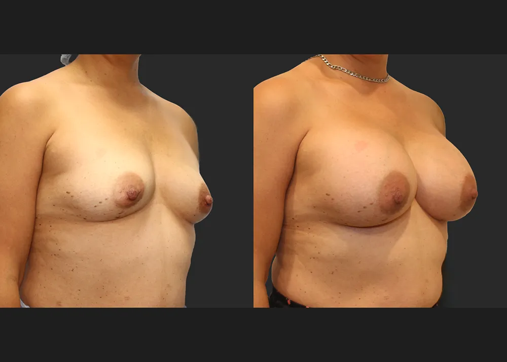 320586 Breast Aug Saline Implants 68 High Profile 500 cc (R 500 L 550) submuscular before after 7 wks right oblique