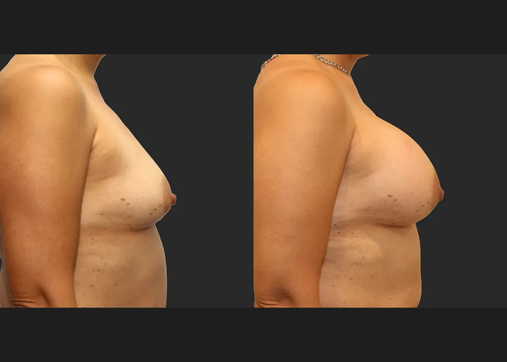 320586 Breast Aug Saline Implants 68 High Profile 500 cc (R 500 L 550) submuscular before after 7 wks right