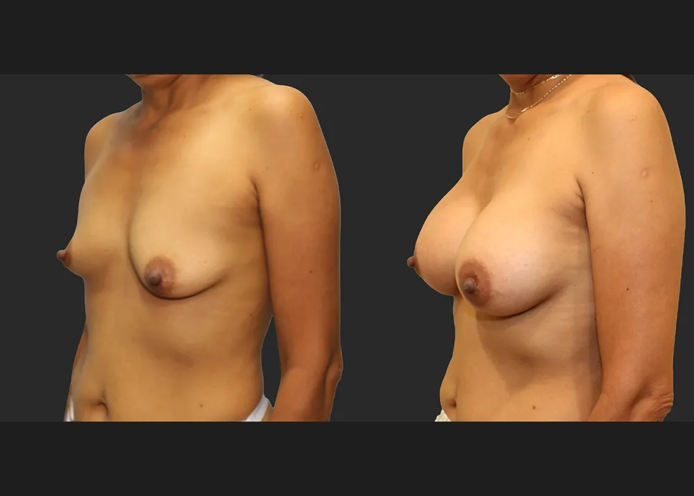321690 Breast Augmentation saline implants Allergan Natrelle High Profile 425 cc Before After 9 wks Left oblique