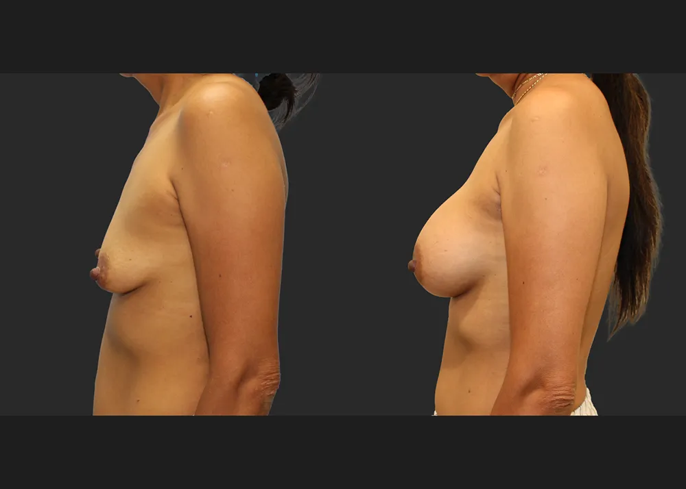 321690 Breast Augmentation saline implants Allergan Natrelle High Profile 425 cc Before After 9 wks Left