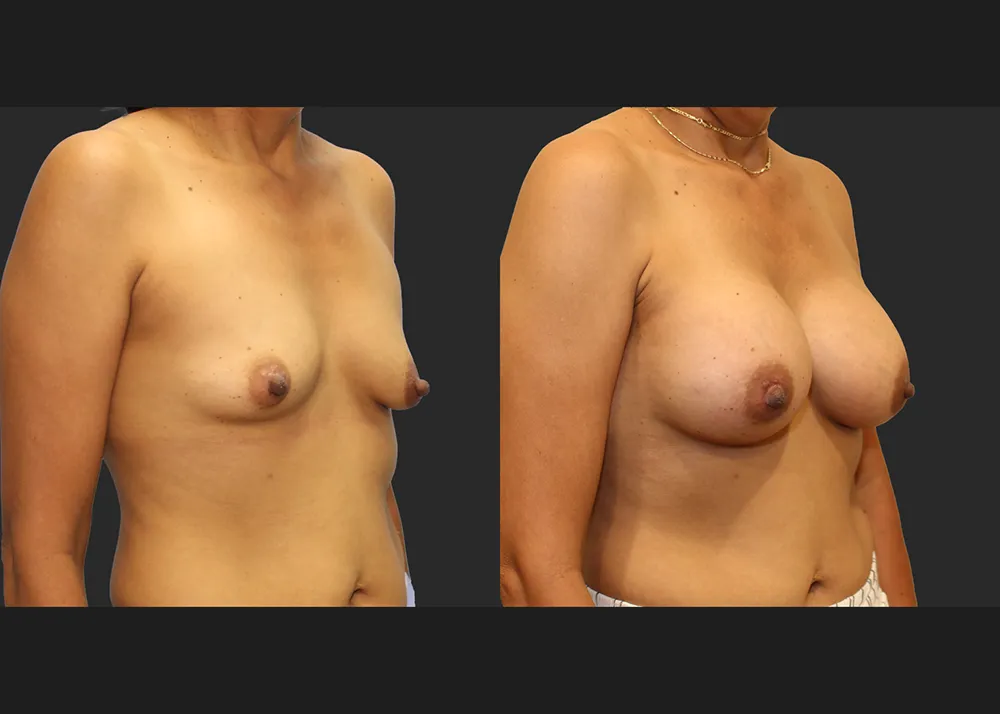 321690 Breast Augmentation saline implants Allergan Natrelle High Profile 425 cc Before After 9 wks Right oblique