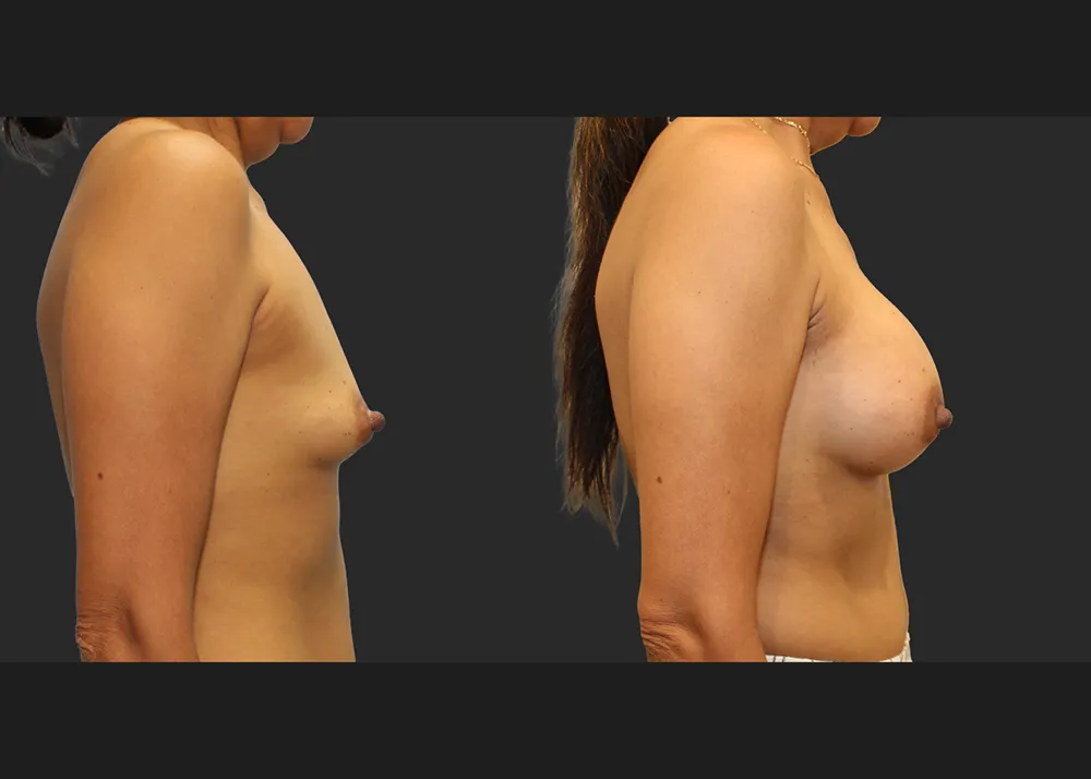 321690 Breast Augmentation saline implants Allergan Natrelle High Profile 425 cc Before After 9 wks Right
