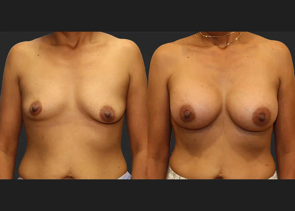 321690 Breast Augmentation saline implants Allergan Natrelle High Profile 425 cc Before After 9 wks