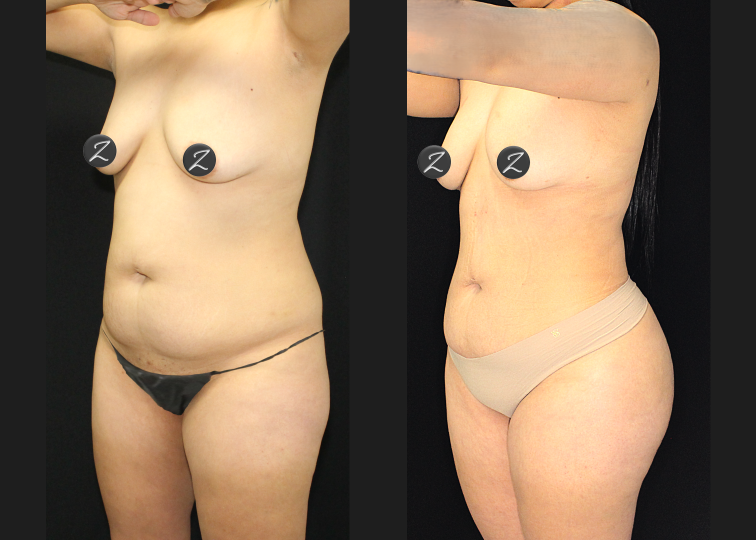 SCSC 12102025 before after left oblique