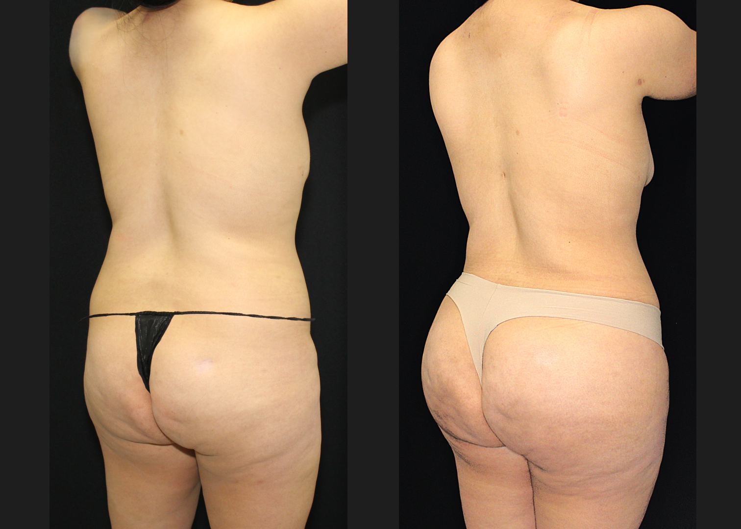 SCSC 12102025 before after right oblique back