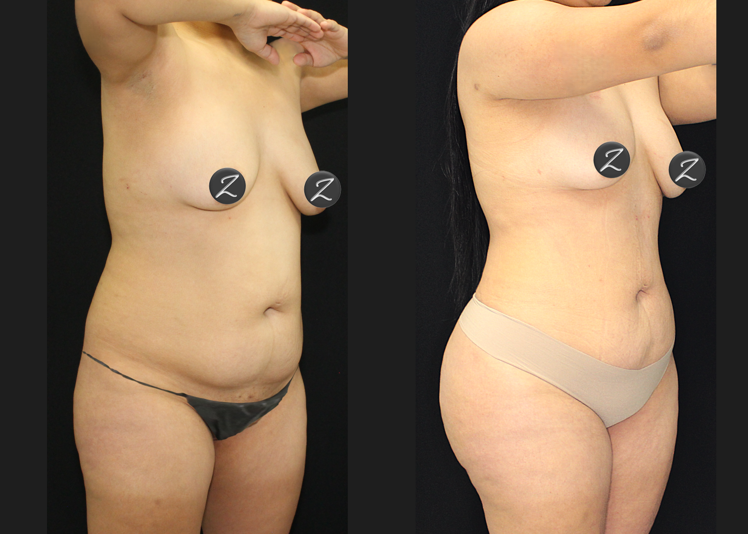 SCSC 12102025 before after right oblique