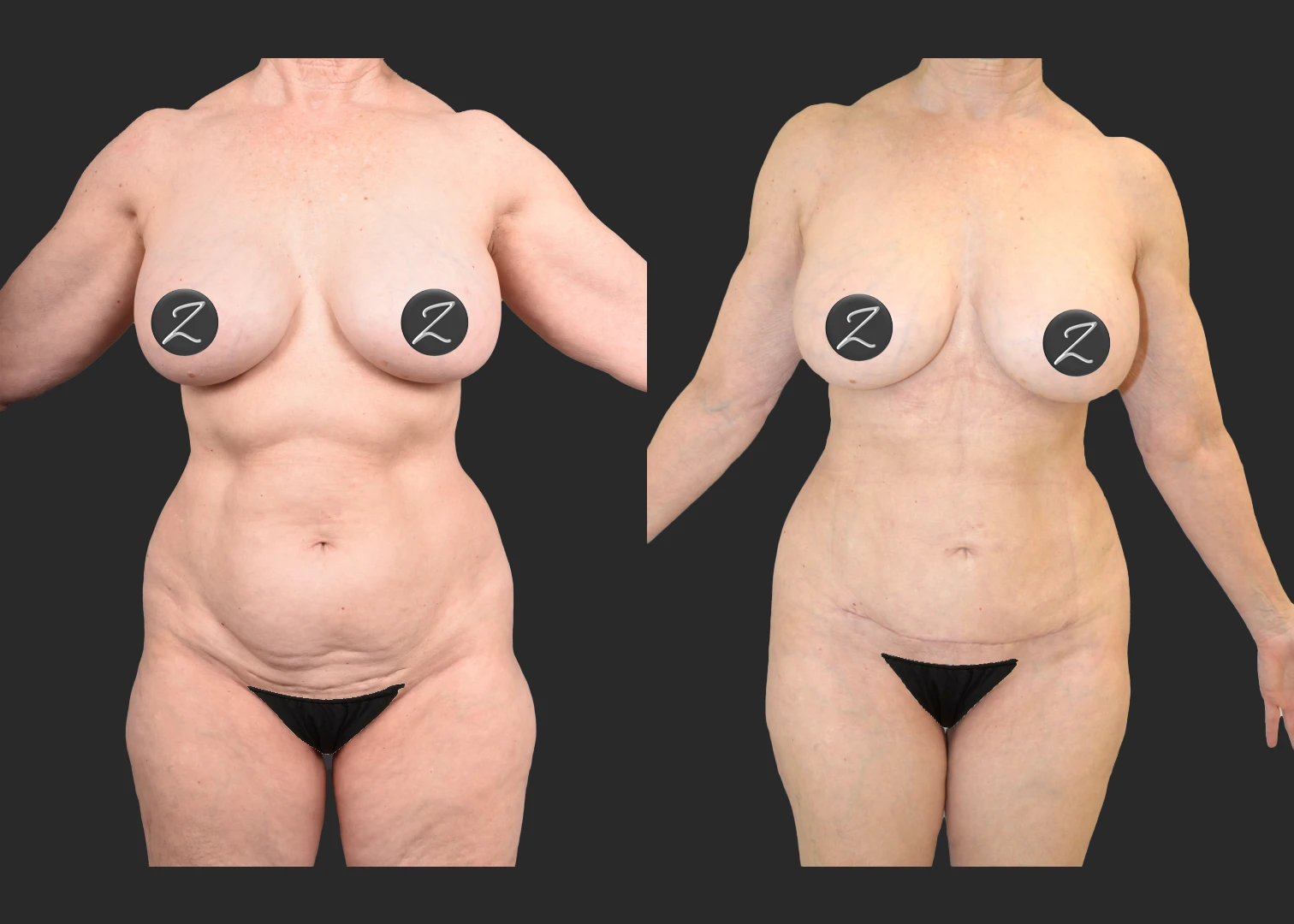 Before and after a liposuction procedure performed by Dr. Maryam Zamani at her Beverly Hills office.