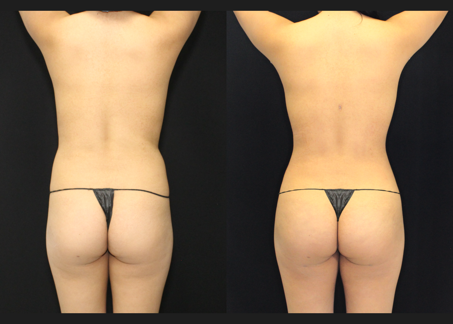 012126_2_S.A.F.E. Power-Assisted Liposuction 360_Abdomen_Upper Back_Lower Back_Flanks_Autologous Fat Transfer to Buttocks_Before and After 5 weeks_Back