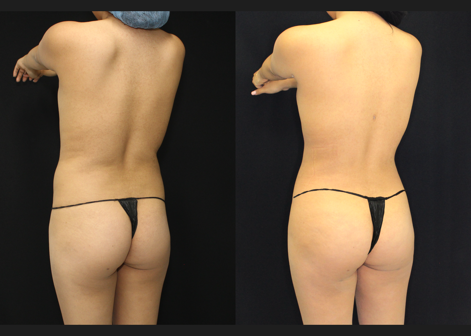 012126_2_S.A.F.E. Power-Assisted Liposuction 360_Abdomen_Upper Back_Lower Back_Flanks_Autologous Fat Transfer to Buttocks_Before and After 5 weeks_Back
