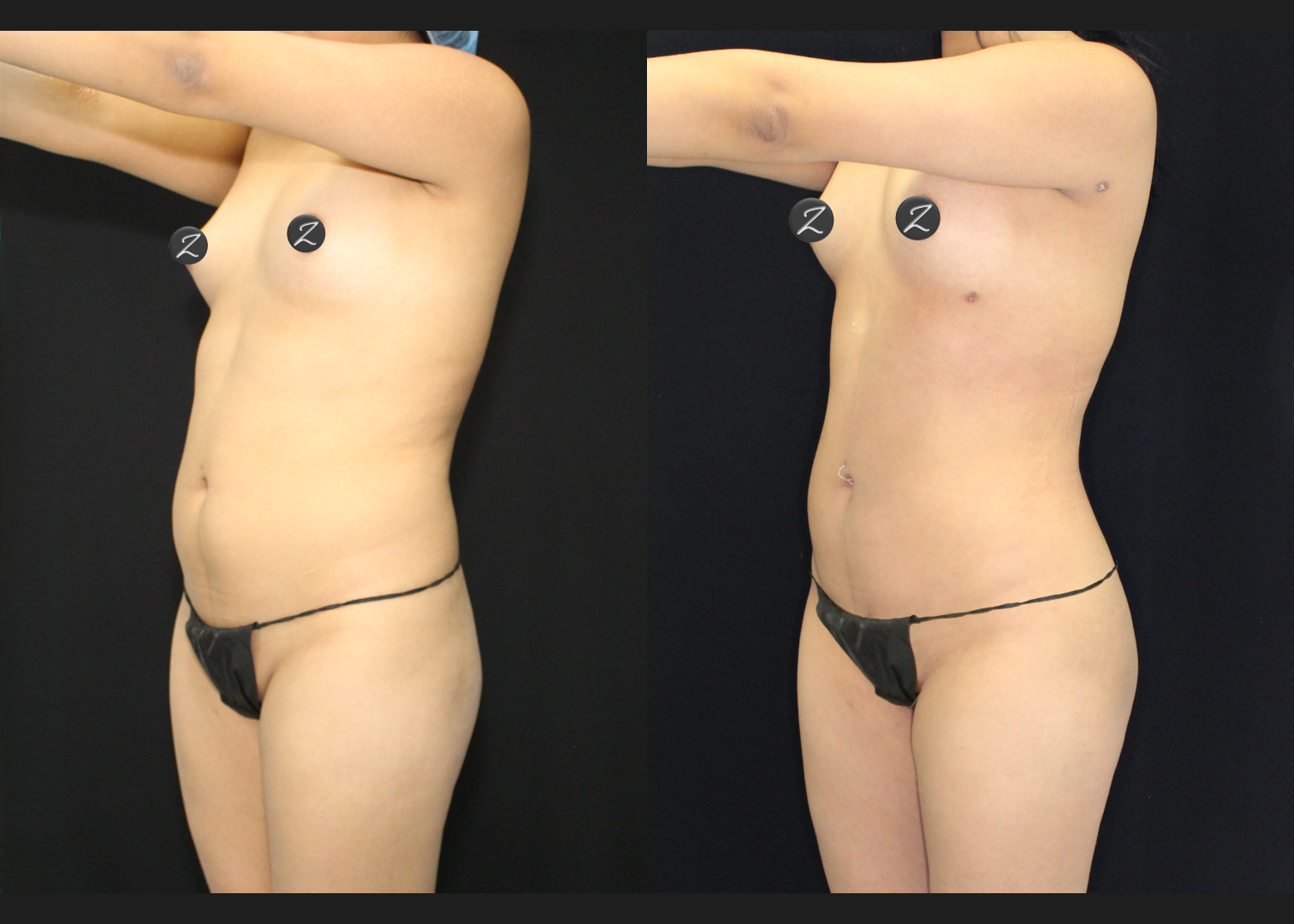 012126_2_S.A.F.E. Power-Assisted Liposuction 360_Abdomen_Upper Back_Lower Back_Flanks_Autologous Fat Transfer to Buttocks_Before and After 5 weeks_Back