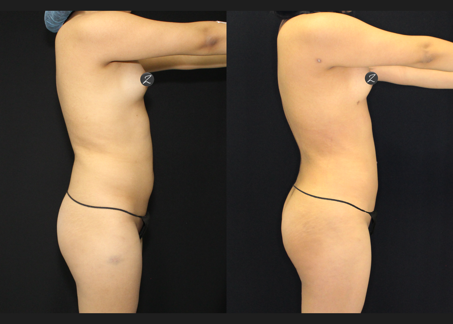 012126_2_S.A.F.E. Power-Assisted Liposuction 360_Abdomen_Upper Back_Lower Back_Flanks_Autologous Fat Transfer to Buttocks_Before and After 5 weeks_Back