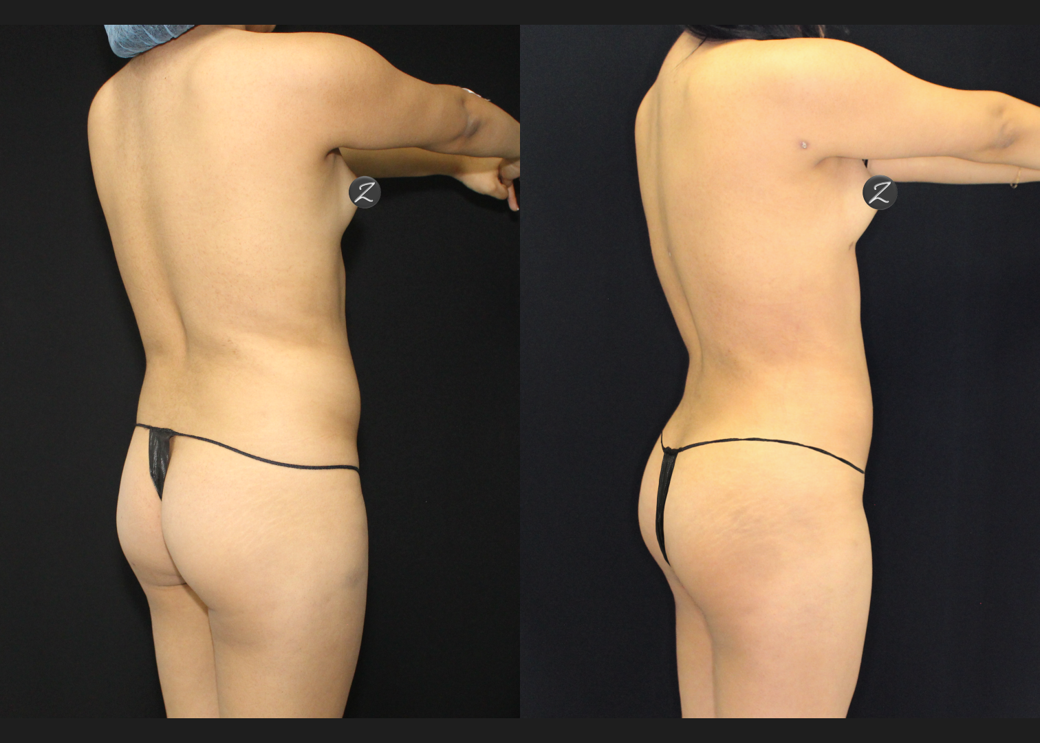 012126_2_S.A.F.E. Power-Assisted Liposuction 360_Abdomen_Upper Back_Lower Back_Flanks_Autologous Fat Transfer to Buttocks_Before and After 5 weeks_Back