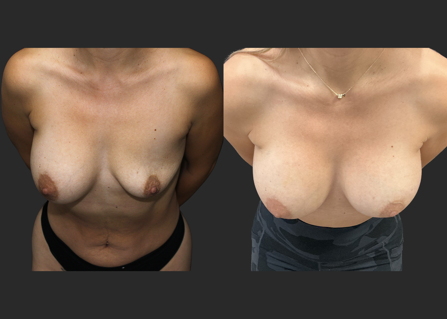 012525_Right Breast Implant Revision_Nagor 360cc Explant_Right Near Total Capsulectomy_SRX 400cc Bilateral_Secondary Left Breast Augmentation_Before and After 1 week_Cleavage
