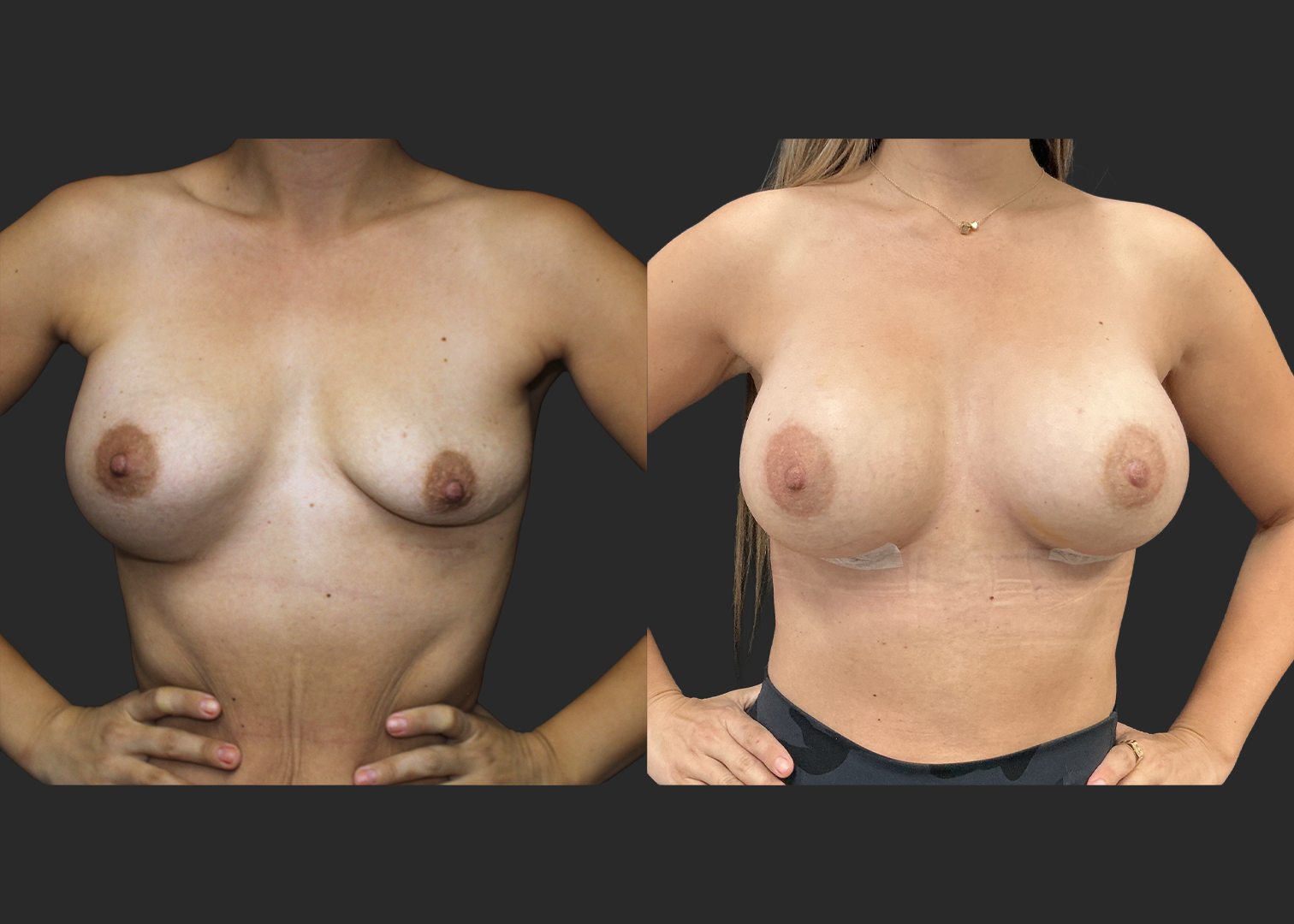 012525_Right Breast Implant Revision_Nagor 360cc Explant_Right Near Total Capsulectomy_SRX 400cc Bilateral_Secondary Left Breast Augmentation_Before and After 1 week_Flex