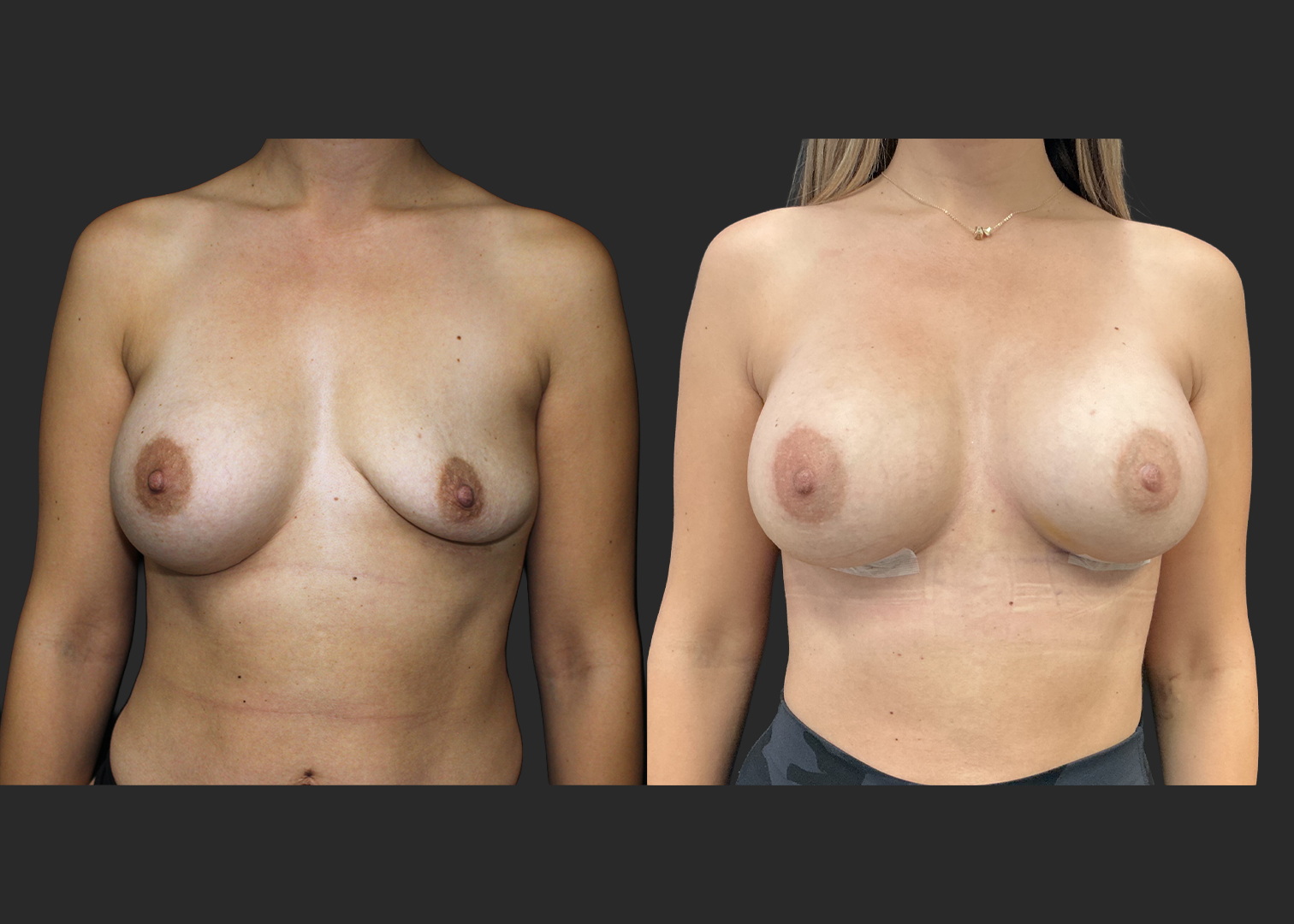 012525_Right Breast Implant Revision_Nagor 360cc Explant_Right Near Total Capsulectomy_SRX 400cc Bilateral_Secondary Left Breast Augmentation_Before and After 1 week_Front