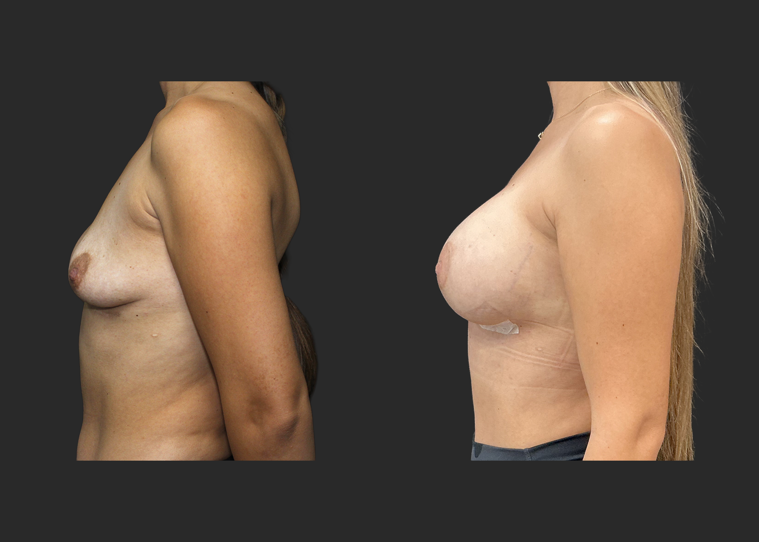 012525_Right Breast Implant Revision_Nagor 360cc Explant_Right Near Total Capsulectomy_SRX 400cc Bilateral_Secondary Left Breast Augmentation_Before and After 1 week_Left