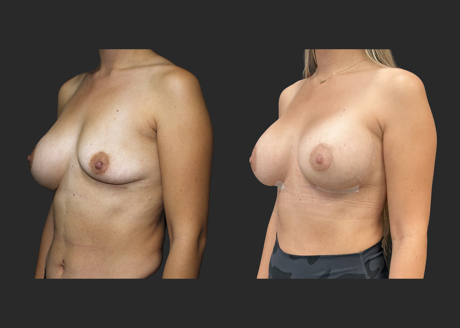 012525_Right Breast Implant Revision_Nagor 360cc Explant_Right Near Total Capsulectomy_SRX 400cc Bilateral_Secondary Left Breast Augmentation_Before and After 1 week_LeftOblique