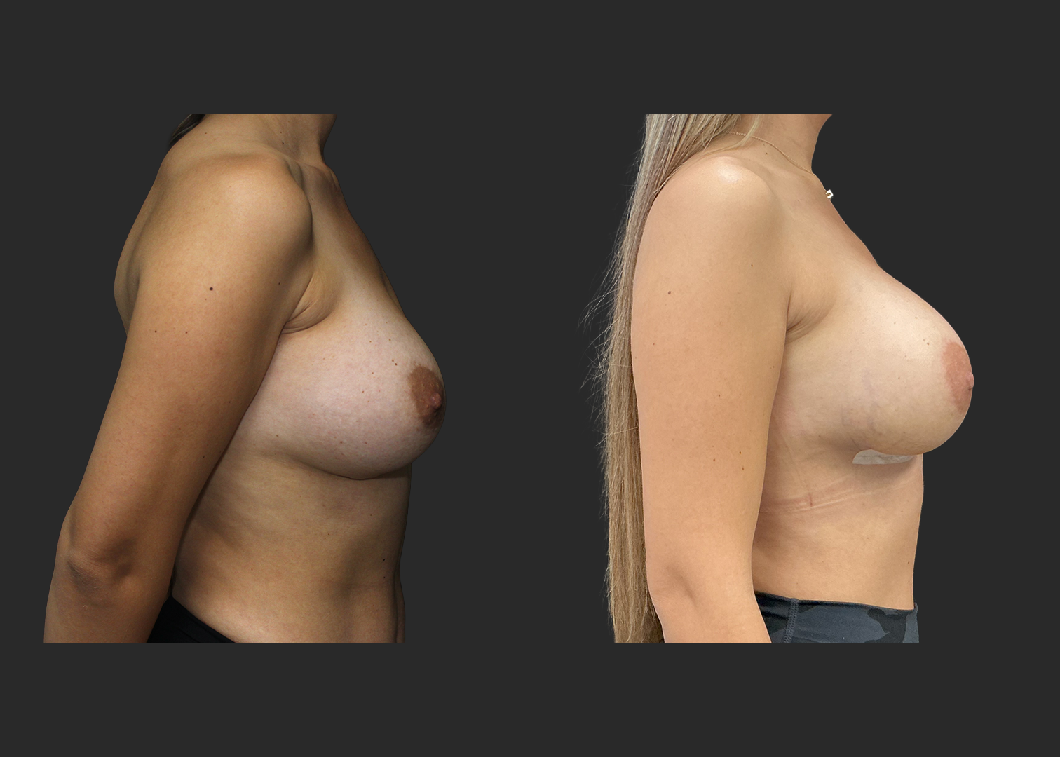 012525_Right Breast Implant Revision_Nagor 360cc Explant_Right Near Total Capsulectomy_SRX 400cc Bilateral_Secondary Left Breast Augmentation_Before and After 1 week_Right