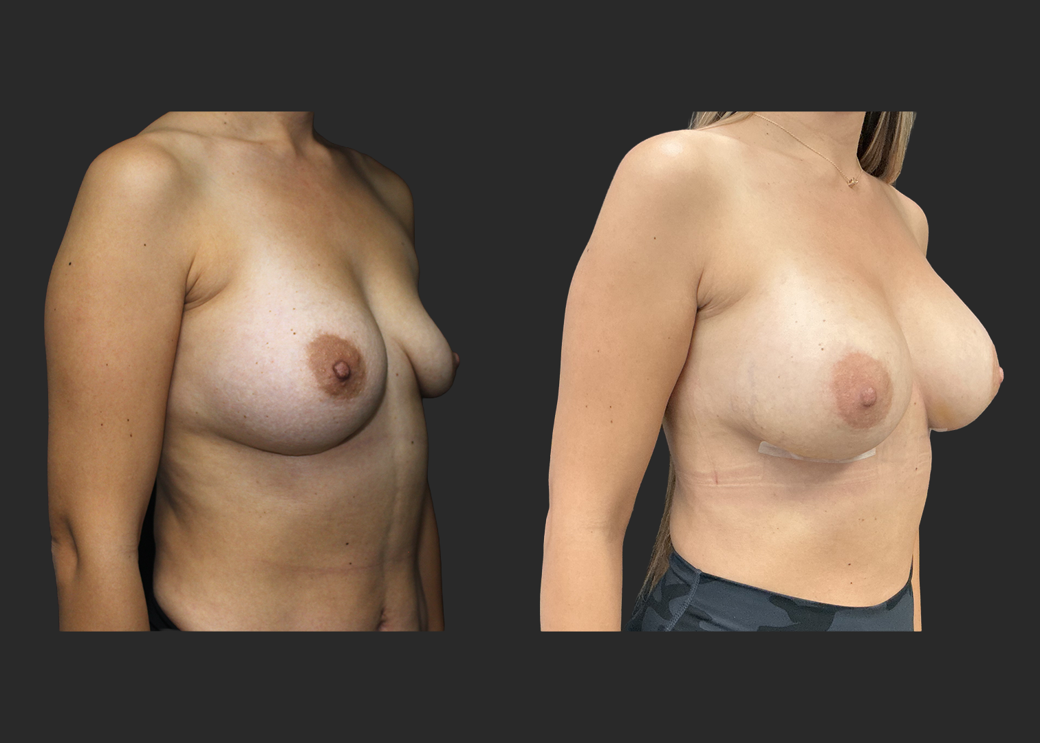 012525_Right Breast Implant Revision_Nagor 360cc Explant_Right Near Total Capsulectomy_SRX 400cc Bilateral_Secondary Left Breast Augmentation_Before and After 1 week_RightOblique