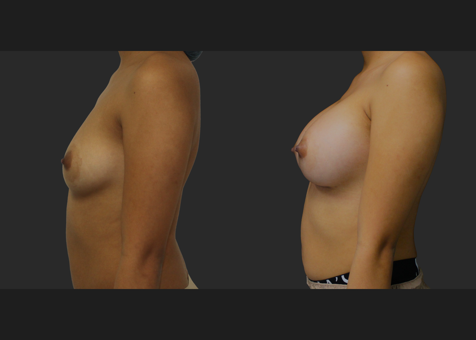 021120261_Breast Augmentation Subpectoral Gummy Bear silicone gel Natrelle Moderate profile SRM 275 cc implants 2 months before after front
