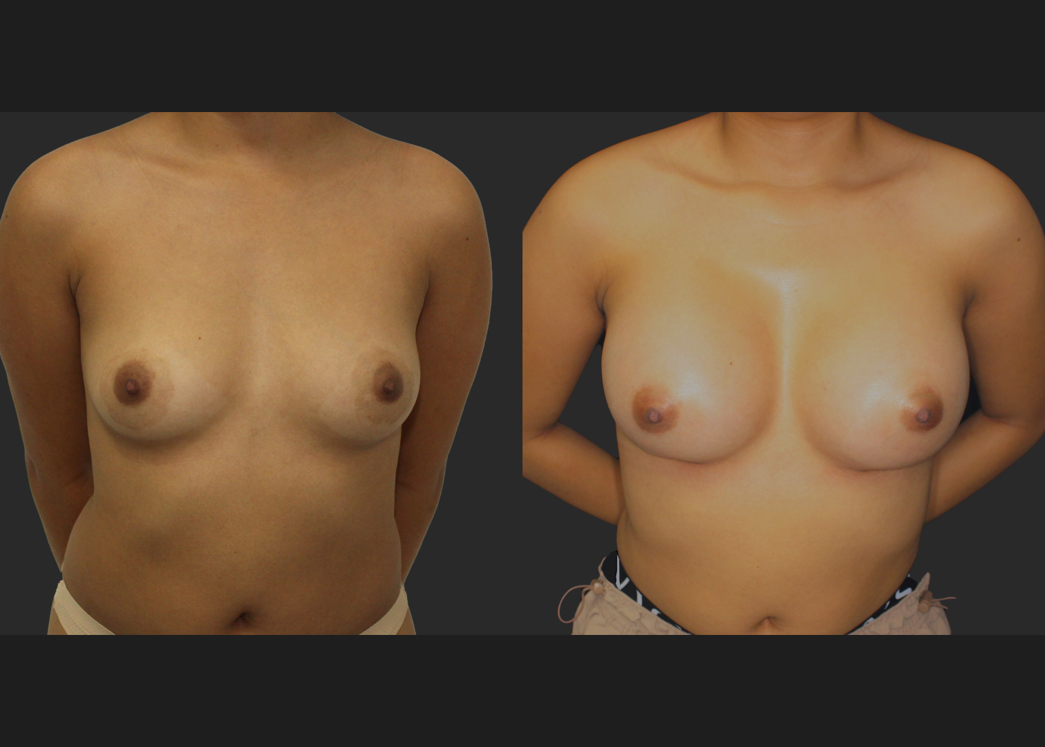 021120261_Breast Augmentation Subpectoral Gummy Bear silicone gel Natrelle Moderate profile SRM 275 cc implants 2 months before after front