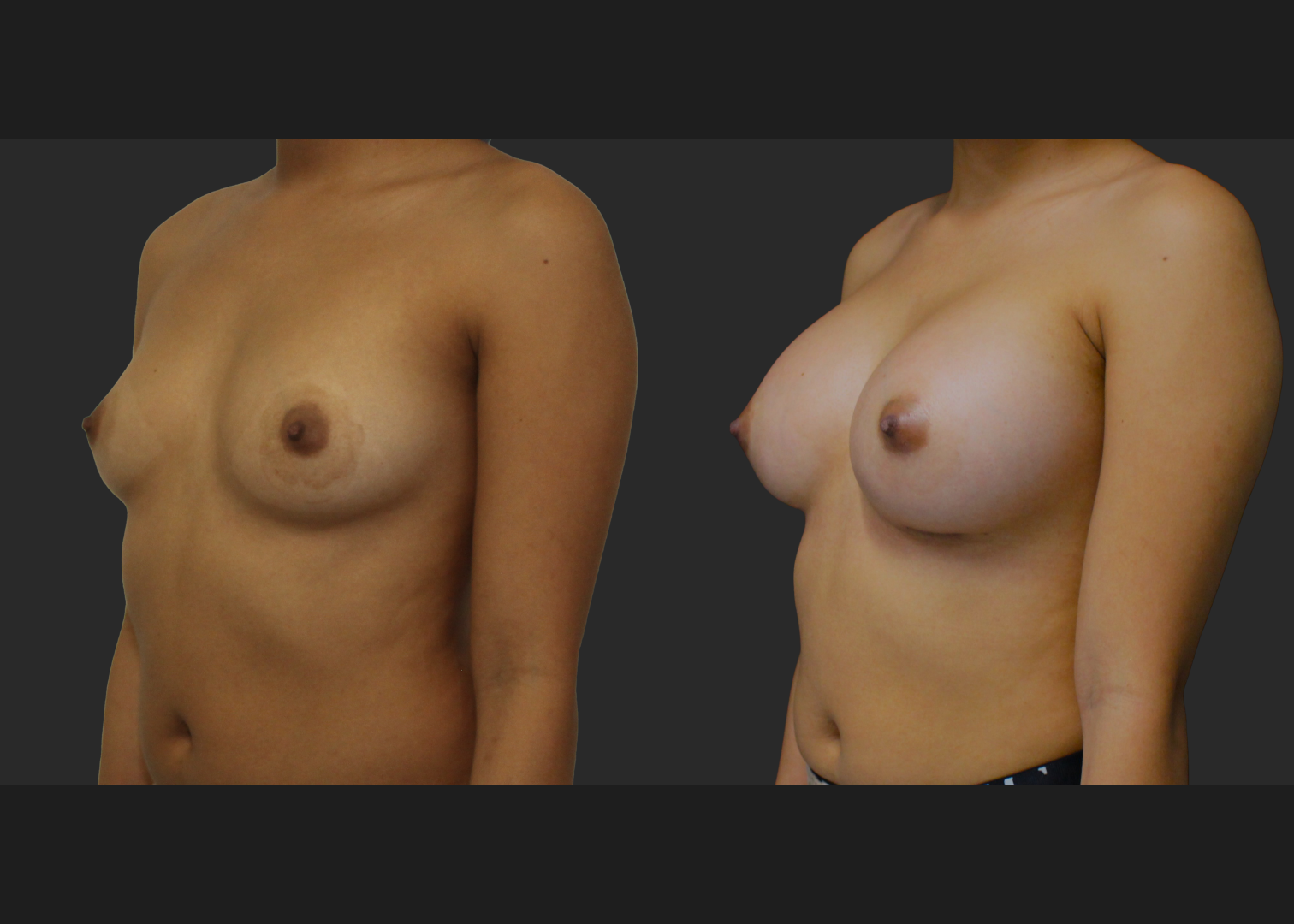 021120261_Breast Augmentation Subpectoral Gummy Bear silicone gel Natrelle Moderate profile SRM 275 cc implants 2 months before after front