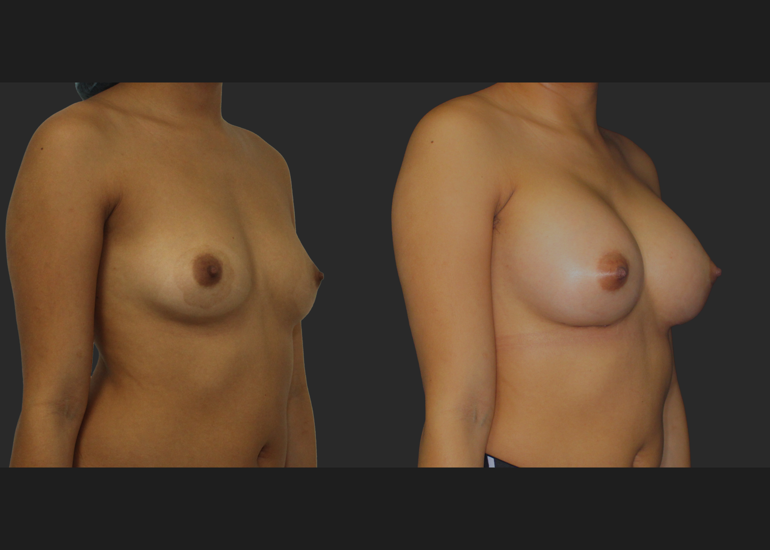 021120261_Breast Augmentation Subpectoral Gummy Bear silicone gel Natrelle Moderate profile SRM 275 cc implants 2 months before after front