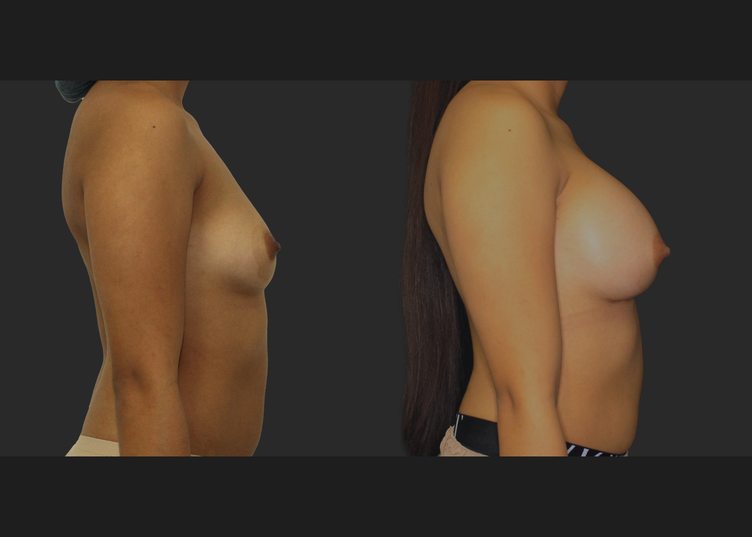 021120261_Breast Augmentation Subpectoral Gummy Bear silicone gel Natrelle Moderate profile SRM 275 cc implants 2 months before after front