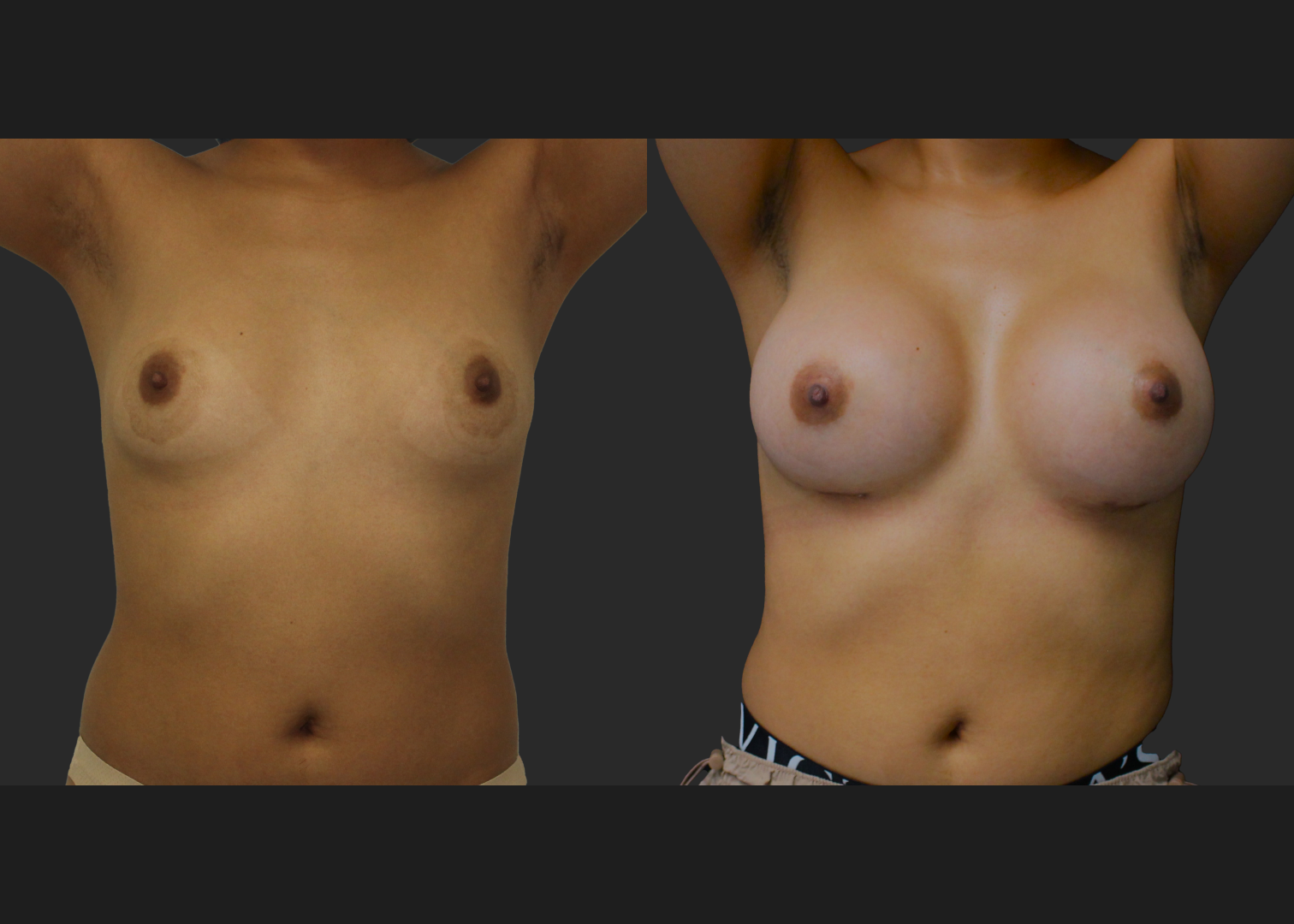 021120261_Breast Augmentation Subpectoral Gummy Bear silicone gel Natrelle Moderate profile SRM 275 cc implants 2 months before after front