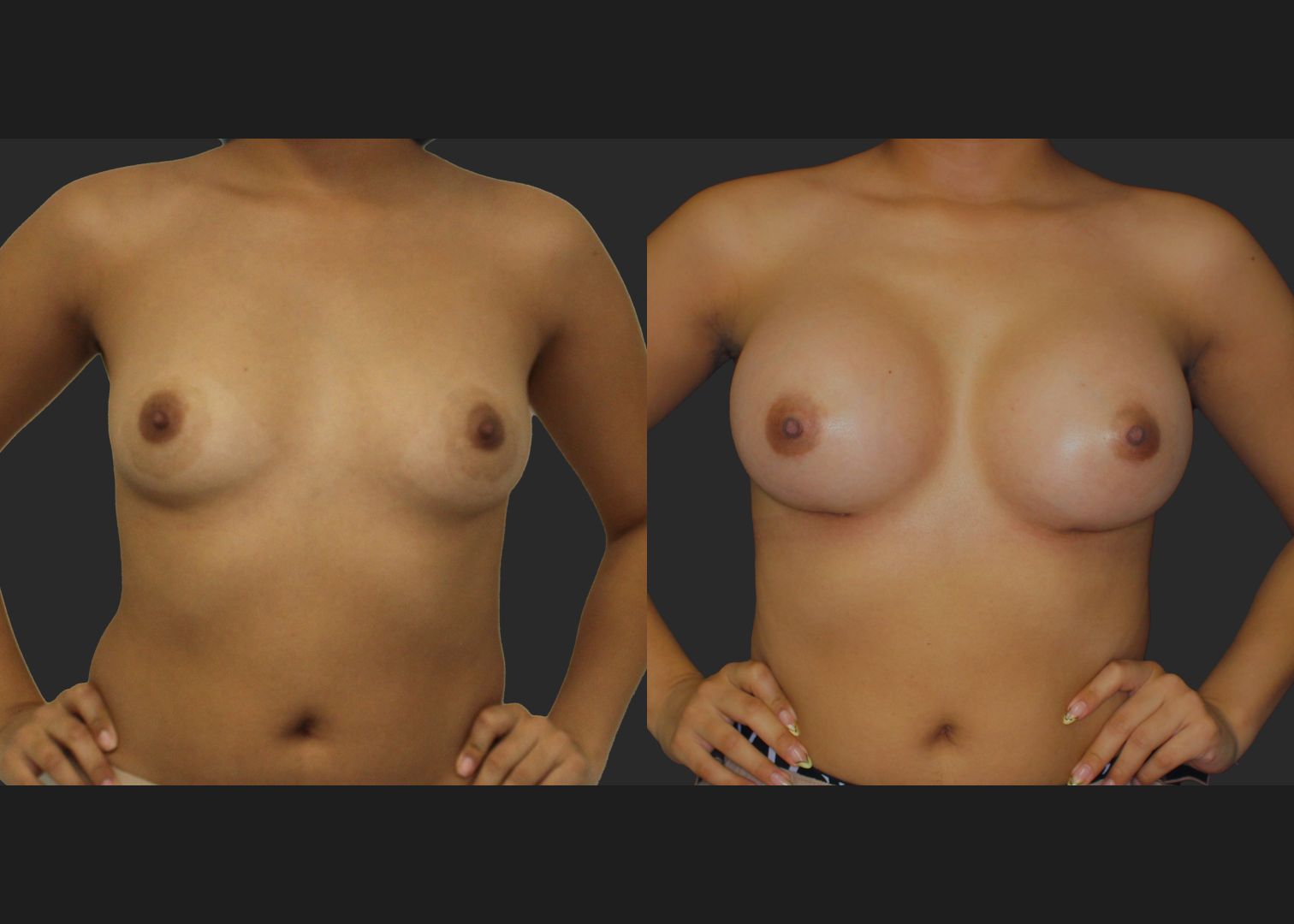 021120261_Breast Augmentation Subpectoral Gummy Bear silicone gel Natrelle Moderate profile SRM 275 cc implants 2 months before after front