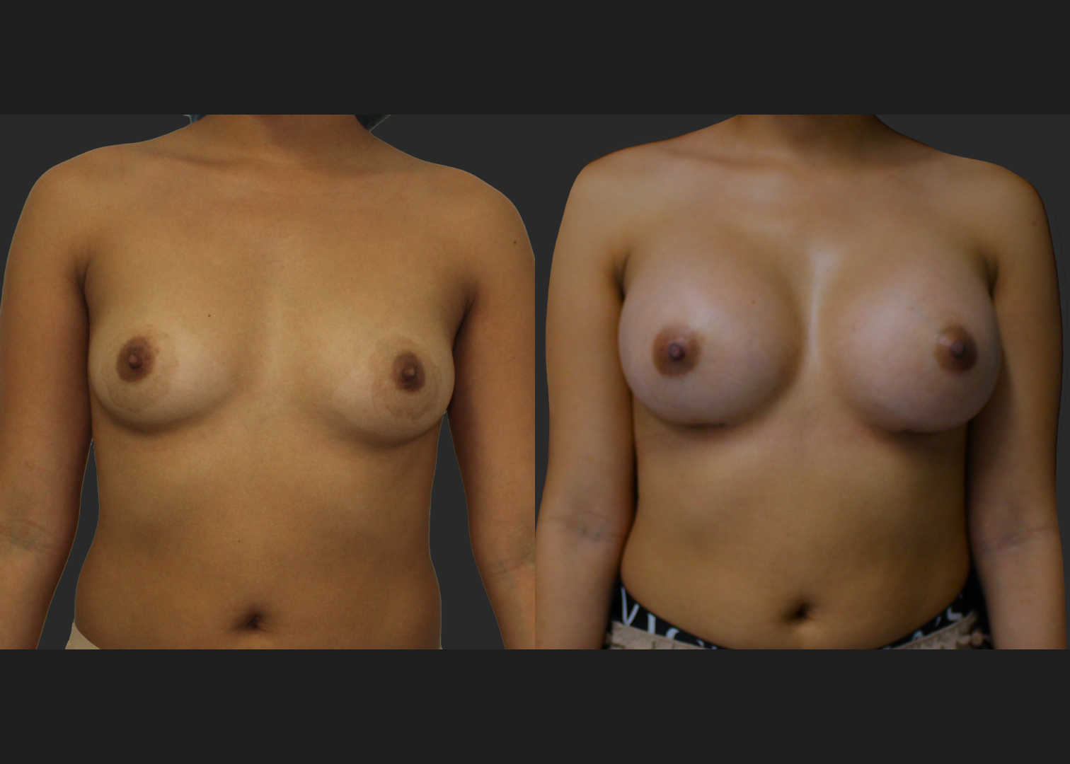 021120261_Breast Augmentation Subpectoral Gummy Bear silicone gel Natrelle Moderate profile SRM 275 cc implants 2 months before after front