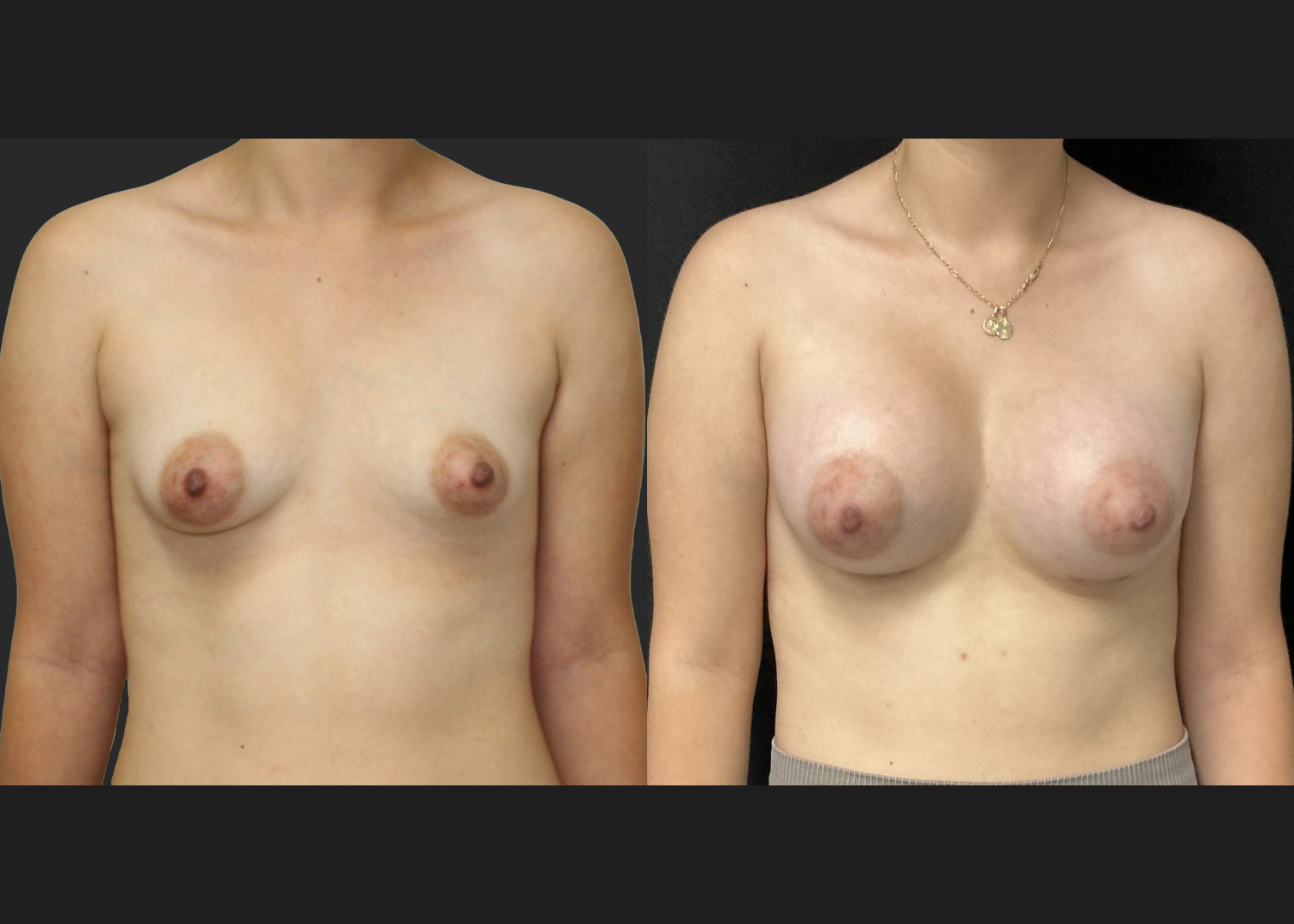 Breast Augmentation_Silicone_SSX Profile_470cc Left_445cc Right_Subfascial_IMF Incision_Before and After 1 month