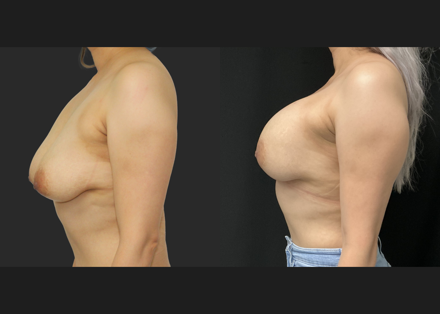 071625_Breast Augmentation_Silicone_SRX 495cc Left_SRF 415cc Right_Subpectoral_Dual Plane IMF Pocket_IMF Incision_Before and After 1 month_Front
