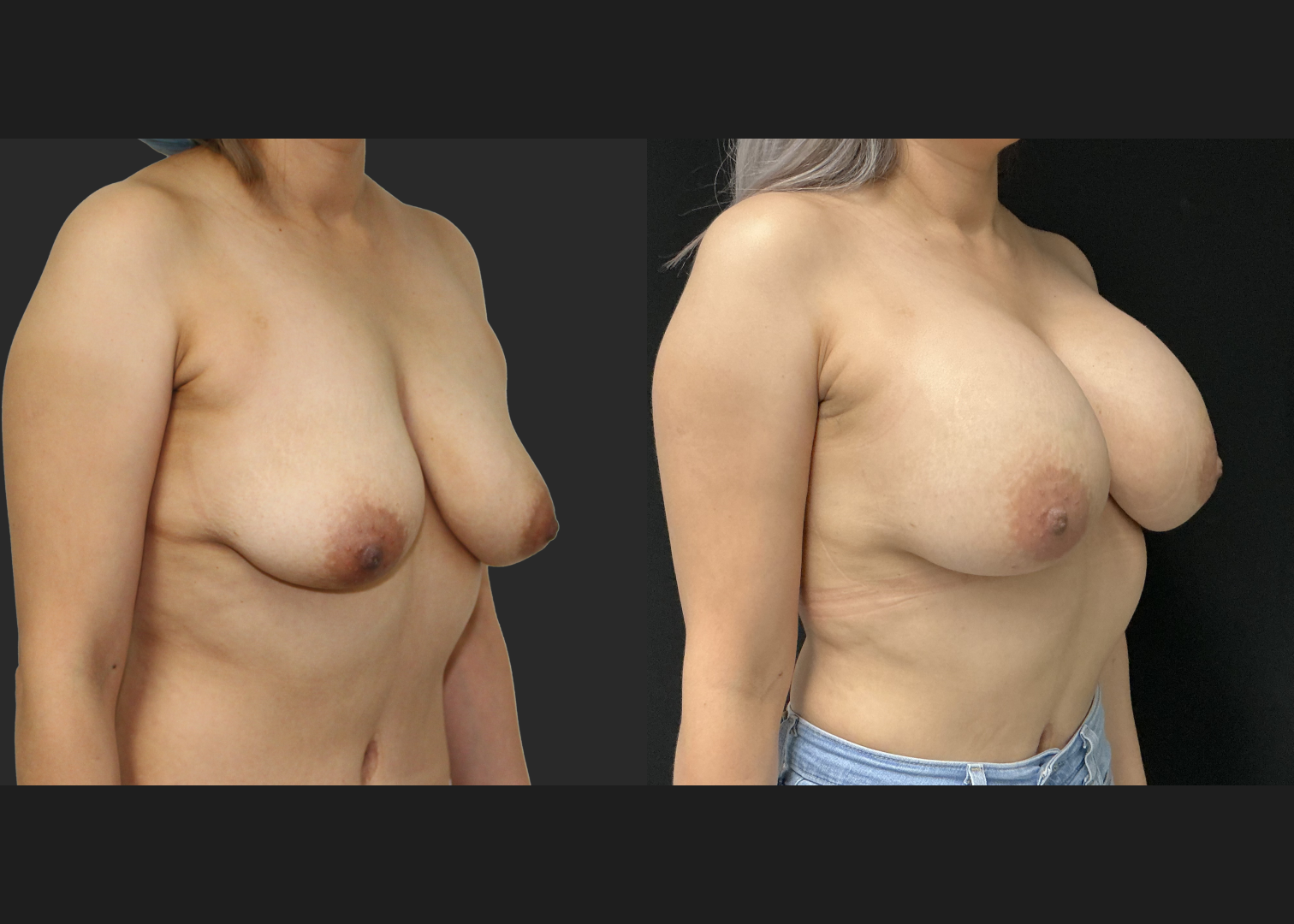 071625_Breast Augmentation_Silicone_SRX 495cc Left_SRF 415cc Right_Subpectoral_Dual Plane IMF Pocket_IMF Incision_Before and After 1 month_Front