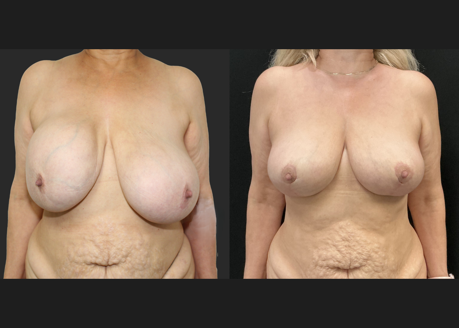 Breast implant removal calcified capsule removal lift and autoaugmentation_Before After 3 mo