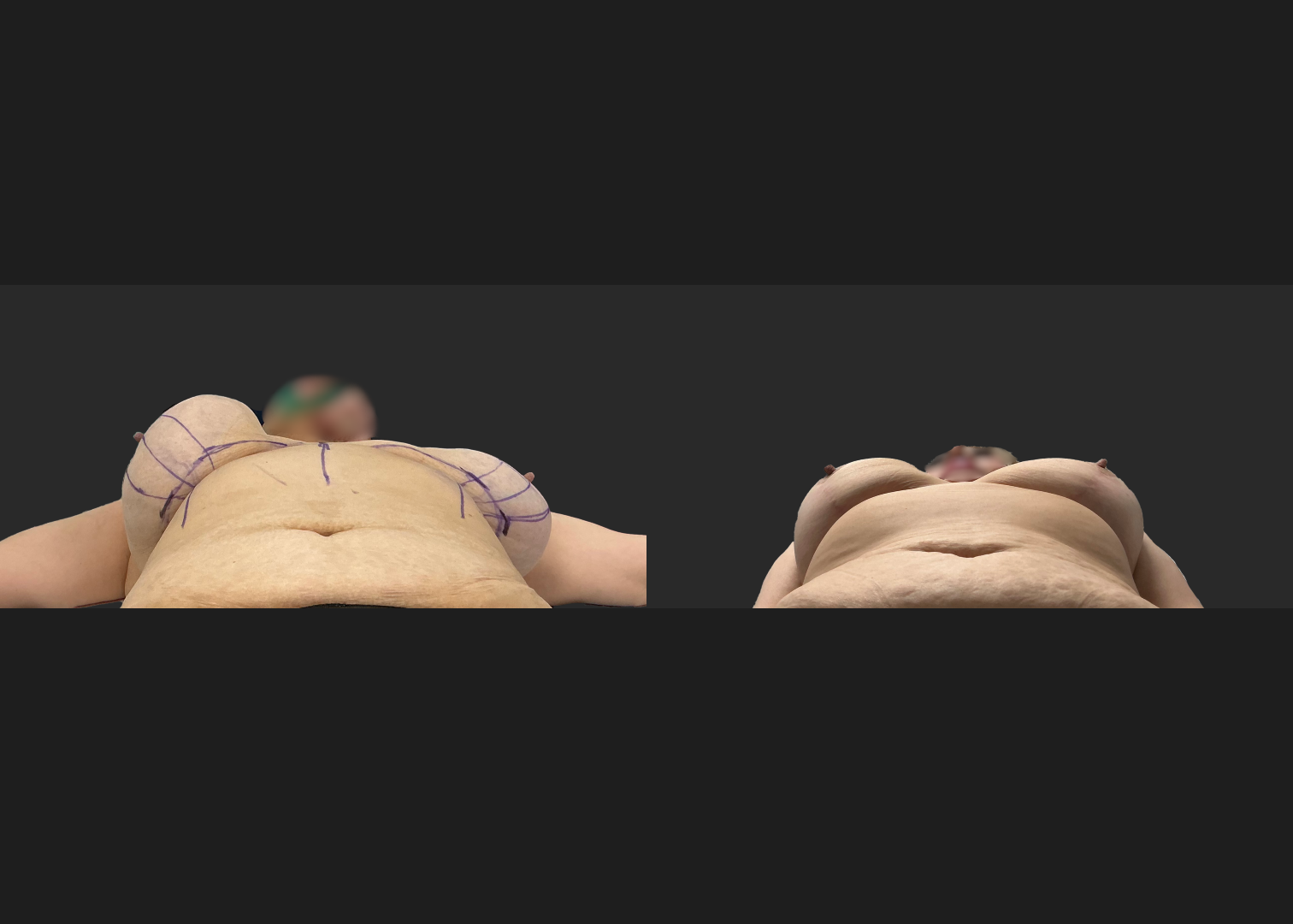 Breast implant removal calcified capsule removal lift and autoaugmentation_Before After 3 mo