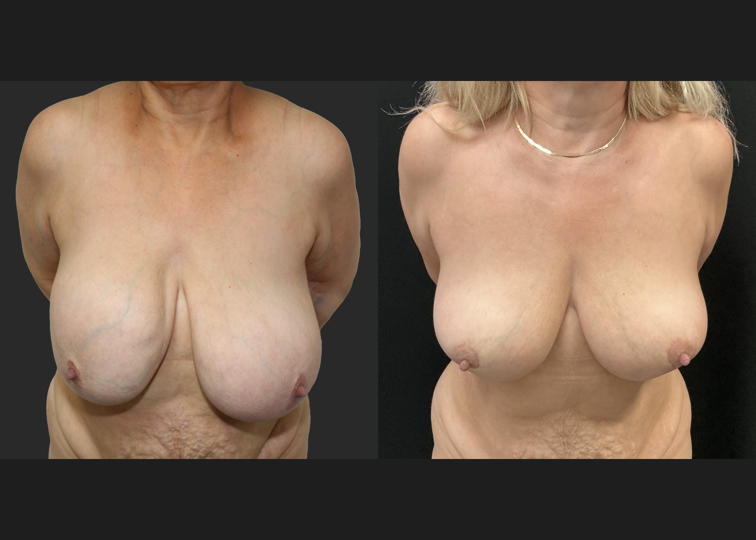 Breast implant removal calcified capsule removal lift and autoaugmentation_Before After 3 mo