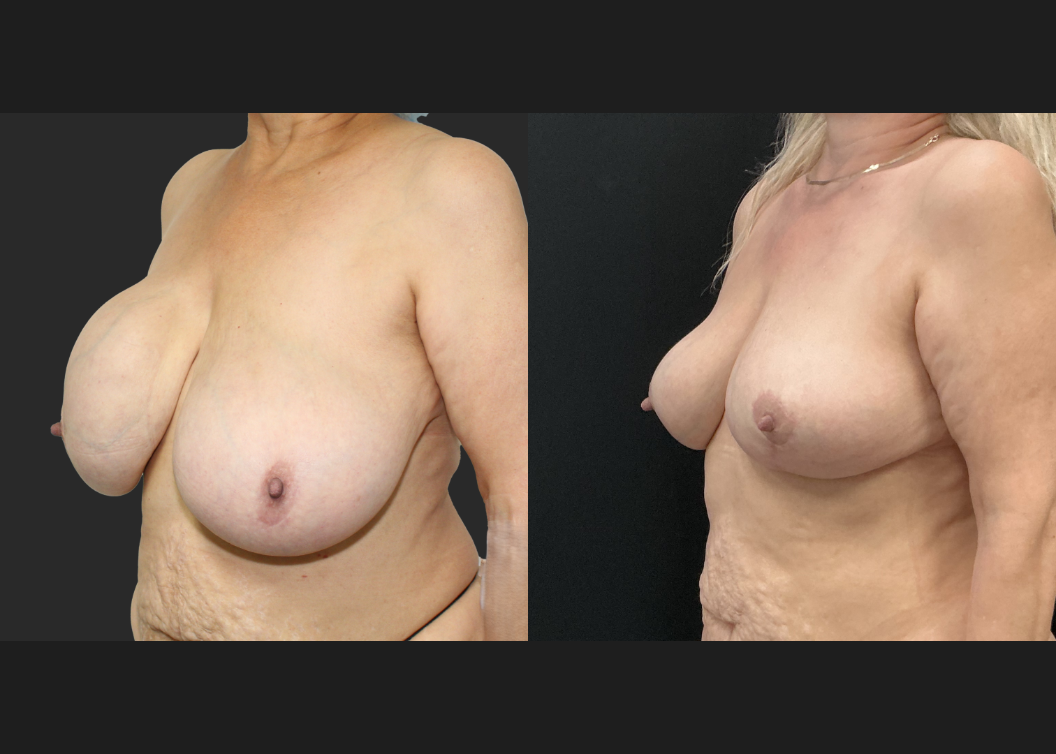 Breast implant removal calcified capsule removal lift and autoaugmentation_Before After 3 mo