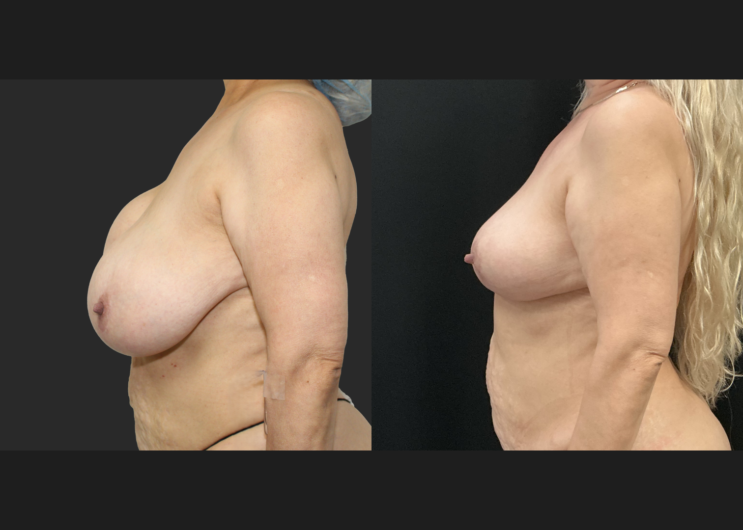 Breast implant removal calcified capsule removal lift and autoaugmentation_Before After 3 mo
