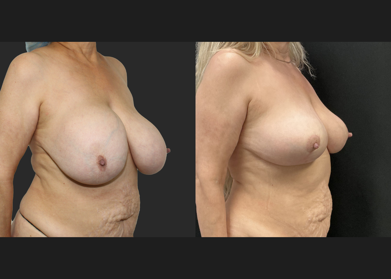 Breast implant removal calcified capsule removal lift and autoaugmentation_Before After 3 mo