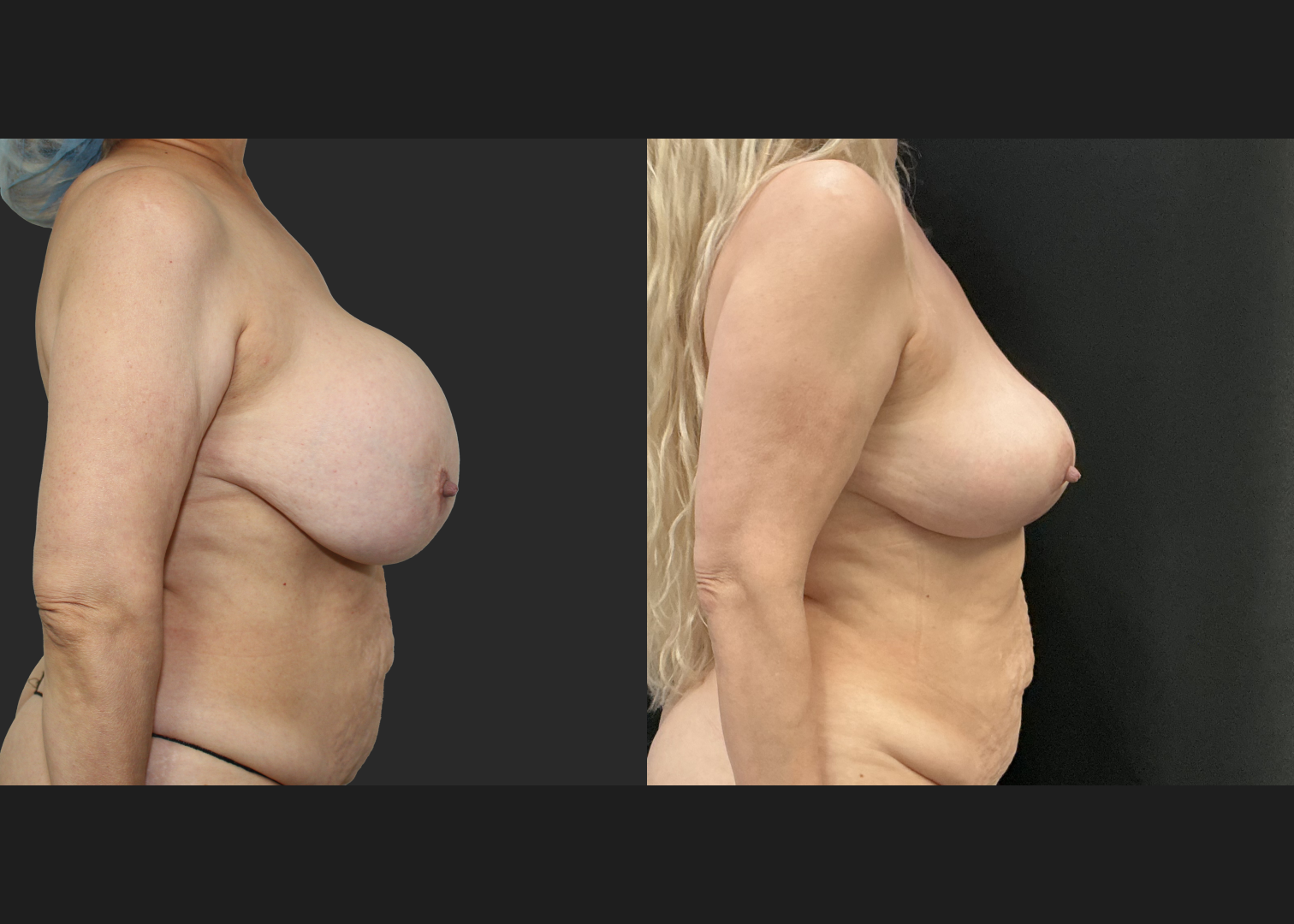 Breast implant removal calcified capsule removal lift and autoaugmentation_Before After 3 mo