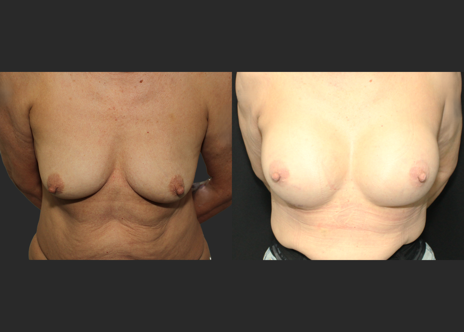 Breast Augmentation Older female 60s Subfascial over the muscle gummy silicone gel implant Natrelle SRM 345 cc