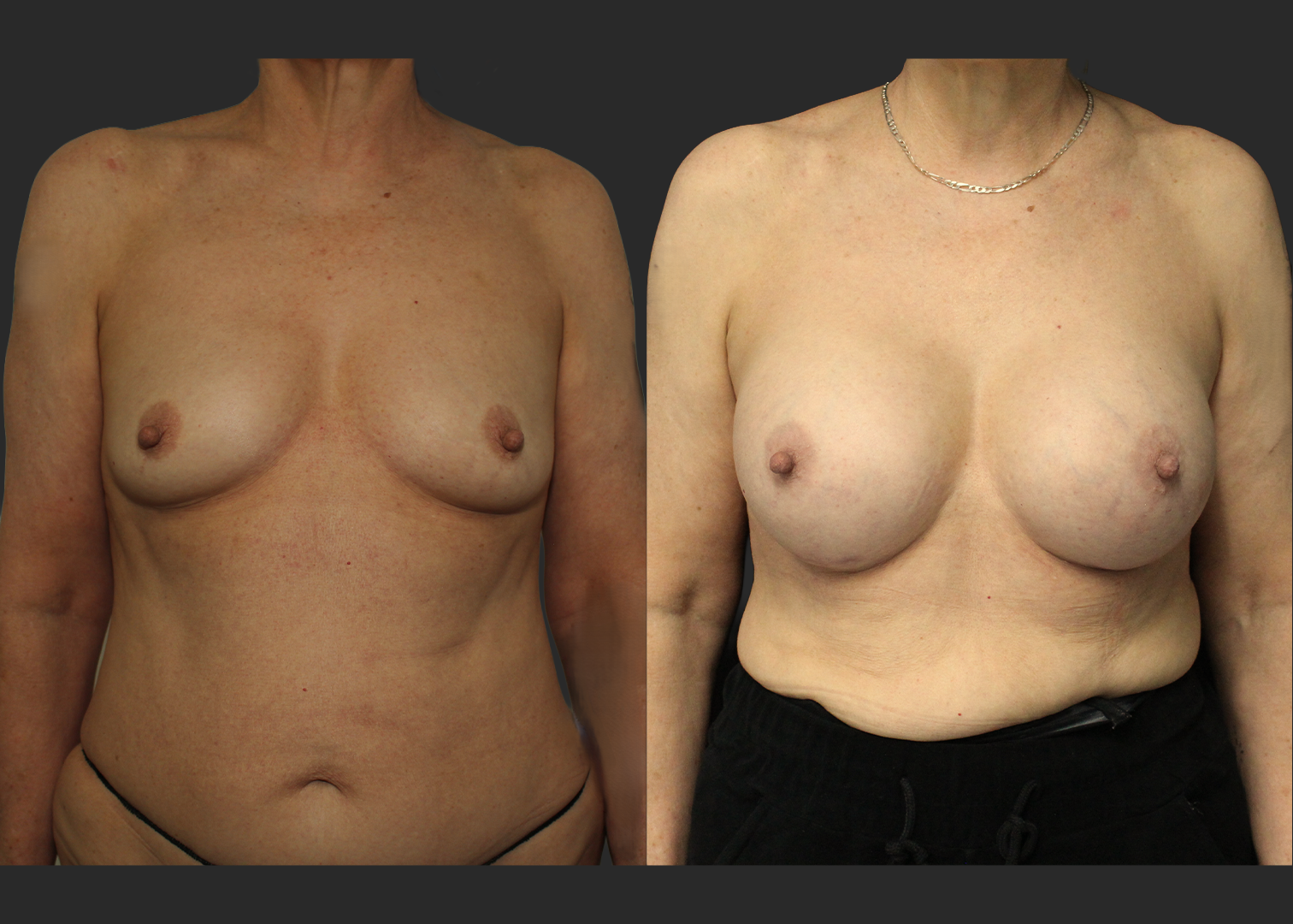 Breast Augmentation Older female 60s Subfascial over the muscle gummy silicone gel implant Natrelle SRM 345 cc