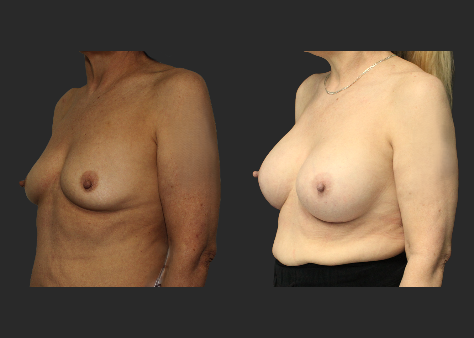 Breast Augmentation Older female 60s Subfascial over the muscle gummy silicone gel implant Natrelle SRM 345 cc